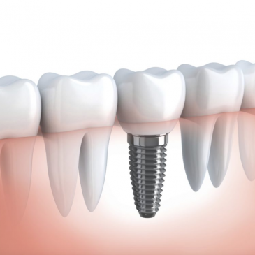 Dental Implants in Fort Myers, FL: Questions to Ask Before Giving It a Go